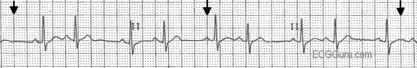 ecg-basics-sinus-rhythm-with-atrial-bigeminy-ecg-guru-instructor